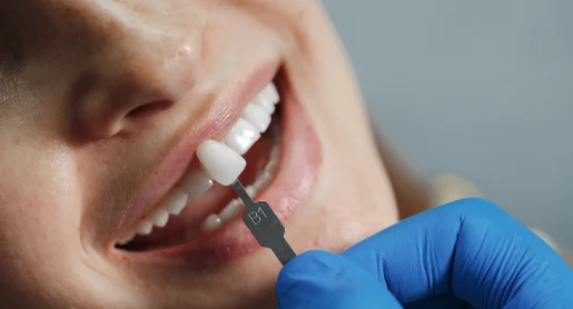 Before Aligners Treatment