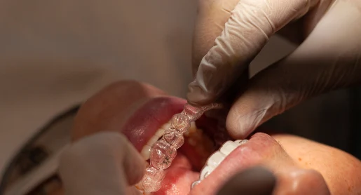 After Aligners Treatment