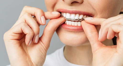 Benefits of Aligners Treatment