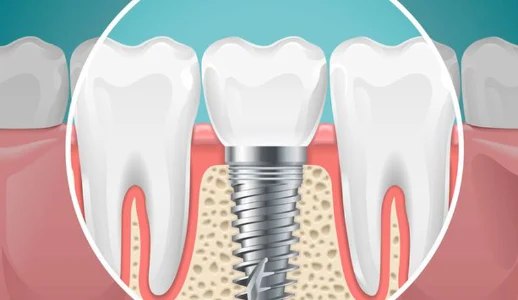 After Dental Implant Treatment