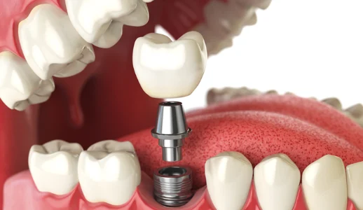Before Dental Implant Treatment