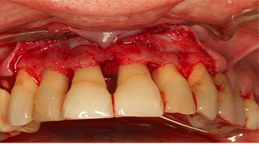 Before Periodontal Flap Surgery Treatment