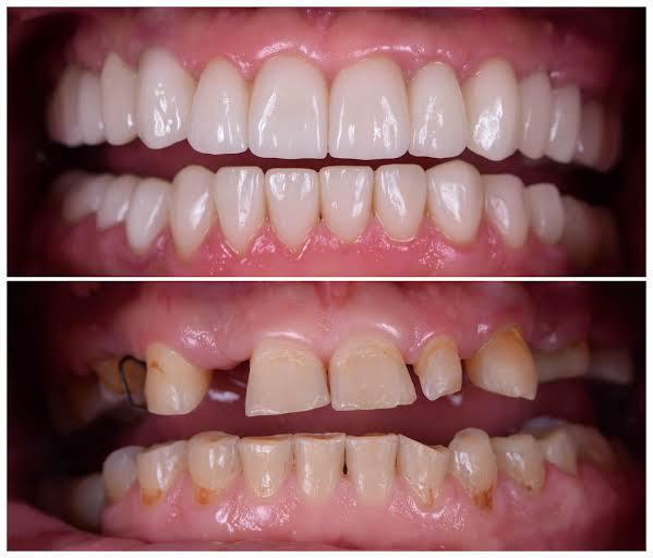 Full mouth rehabilitation