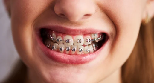 Before Orthodontic Treatment