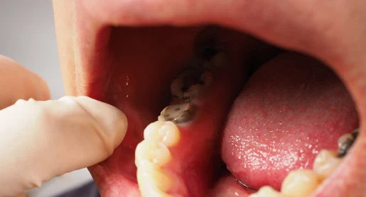 Before Root Canal Treatment