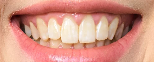 Before Teeth Whitening Treatment